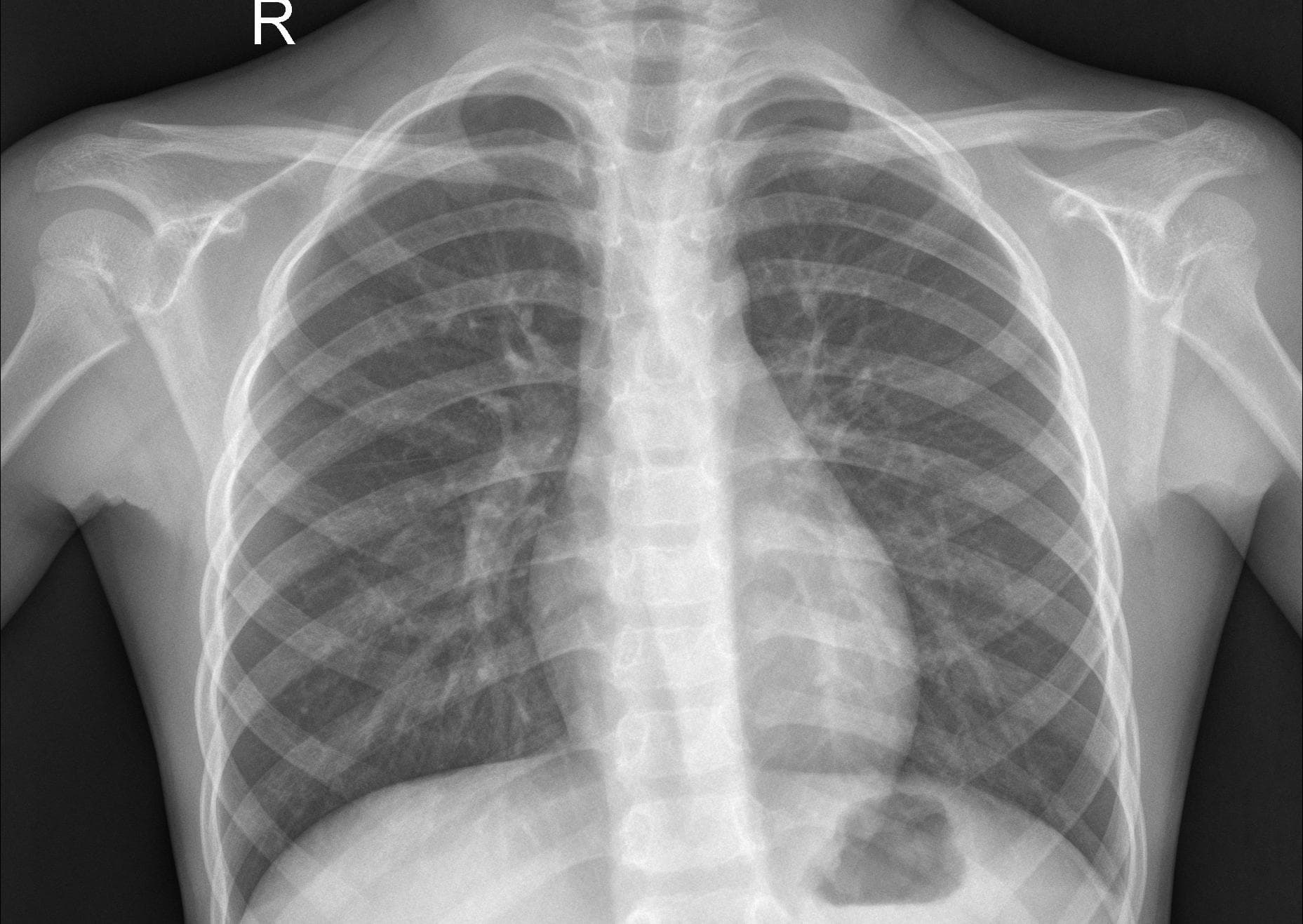 Pneumonia detection and classification